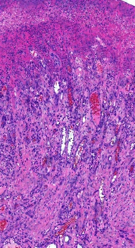 Pathology Of Pyogenic Granuloma Pathology Blog