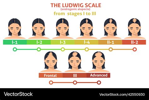 Ludwig scale of androgenic alopecia step poster Vector Image