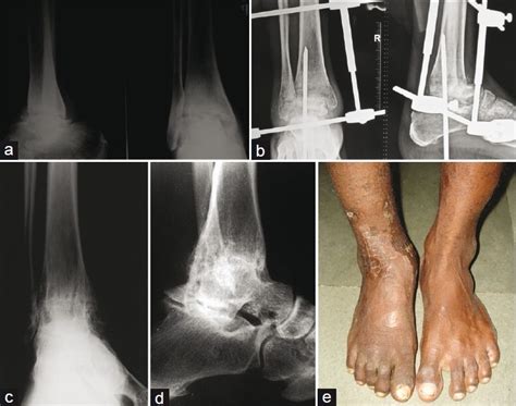 A Preoperative X Ray Of Right Ankle Showing Arthritic Changes B