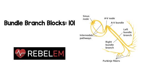 Bundle Branch Blocks - REBEL EM - Emergency Medicine Blog