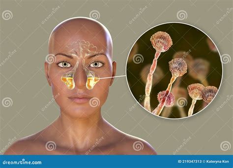 Aspergillus Fungi As A Cause Of Sinusitis 3d Illustration Stock