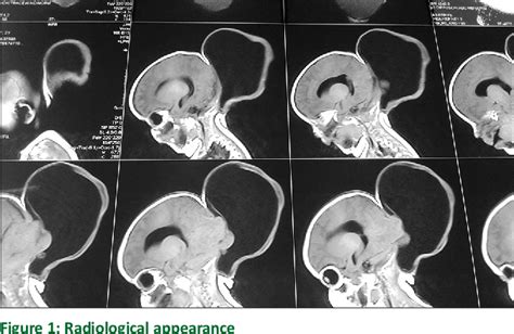 Figure From Giant Meningoencephalocele With Arnold Chiari Type Iii