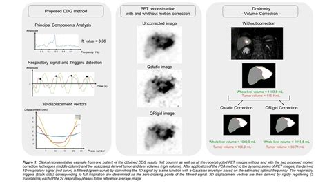 Data Driven Motion Correction For 90y Pet Imaging Application To Sirt