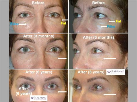 Tips To Speed Recovery After Eyelid Surgery