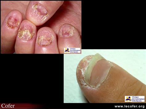 Psoriasis Psoriasis unguéal Psoriasis des ongles Diapothèque du COFER