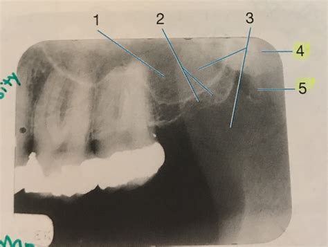 Pterygoid Plate Radiograph