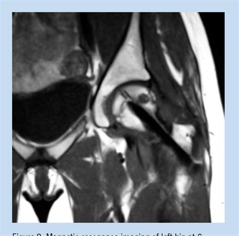 Figure 2 From A Displaced Femoral Neck Stress Fracture In An