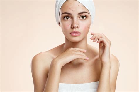 Adult Acne Causes And Remedies Expert Tips