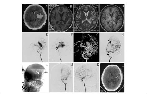 Figure E A Preoperative Ct Shows Intracranial Hematoma In Left Basal