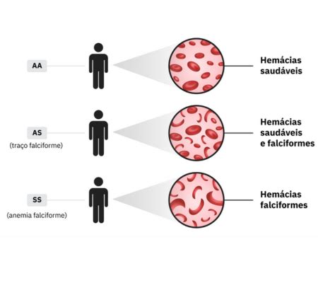 Desvendando a Anemia Falciforme Conhecimento Cuidado e Promoção da