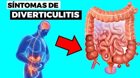 Los Síntomas De Diverticulitis Salud Videos