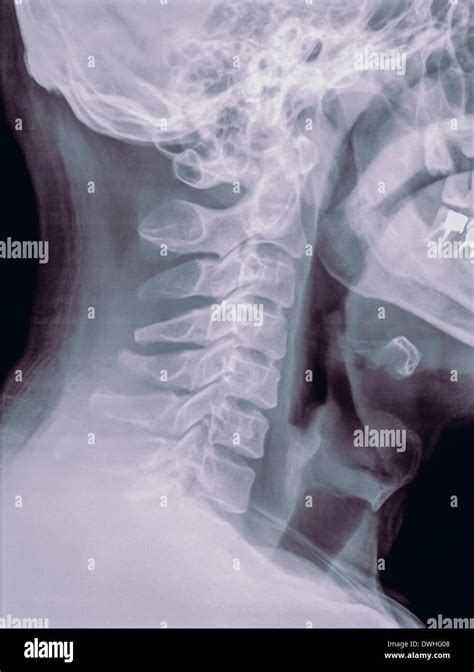 Cervical Spine X Ray Of A Year Old Male Patient Side View Stock