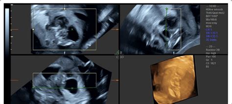 4D pregnancy ultrasound of the fetus | Download Scientific Diagram