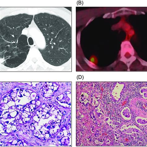 Computed Tomography Ct And F Fluorodeoxyglucose Positron Emission