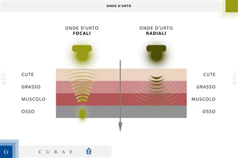 Onde D Urto Focali Cosa Sono Differenza Con Le Radiali E Durata