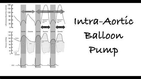 Intra Aortic Balloon Pump Iabp Youtube