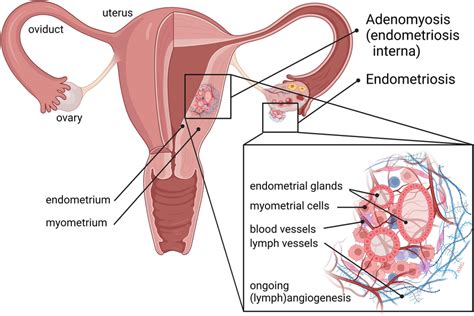 Angiogenesis Is A Feature Of Endometriosis And Adenomyosis