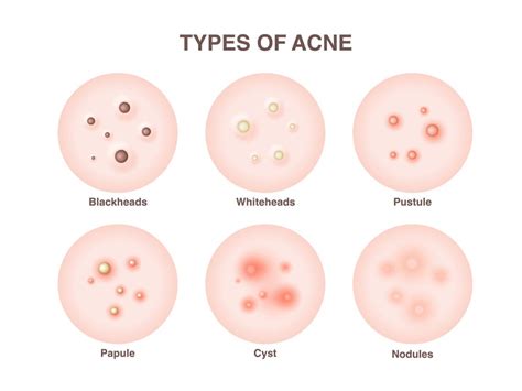 Types And Causes Of Acne Part 2 — Skinand Medical Aesthetic Clinic