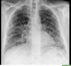 Radiology Quiz 4 Cardiac And Pneumonia Quizlet