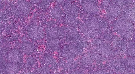 Follicular lymphoma | Ottawa Atlas of Pathology