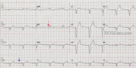 Paced Rhythm Following AV Node Ablation | ECG Guru - Instructor Resources