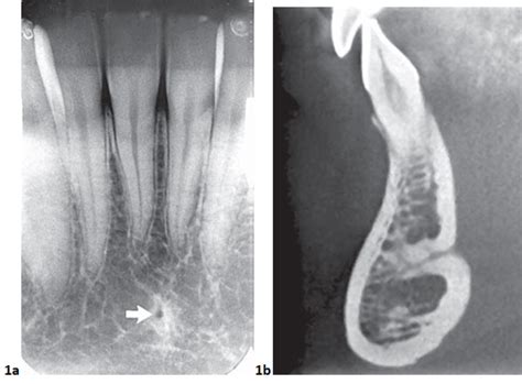 Mandibular Foramen Radiograph