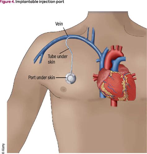 What Is A Venous Access Device And What Types Are Used For Cancer