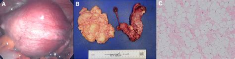 Fatty Intrusion In The Uterus A Rare Case Of Uterine Lipoleiomyoma