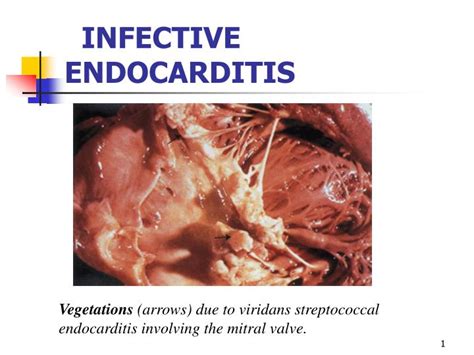 Ppt Infective Endocarditis Powerpoint Presentation Free Download Id 3356938