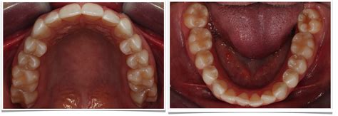 Tips For Exquisite Intra Oral Dental Photography