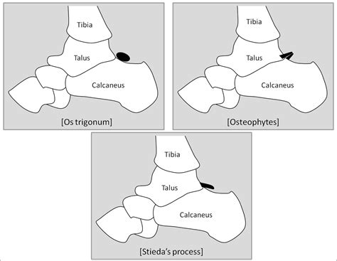 Posterior Ankle Impingement In Athletes Pathogenesis Imaging Features