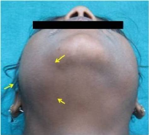 Figure From Management Of Unicystic Plexiform Ameloblastoma In A