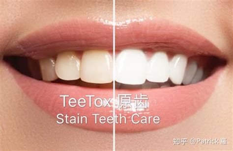 牙齿美白的利與弊 Teetox 知乎