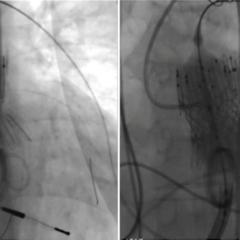 Positioning Of The Sapien Valve In Between Both Stent Parts Of The