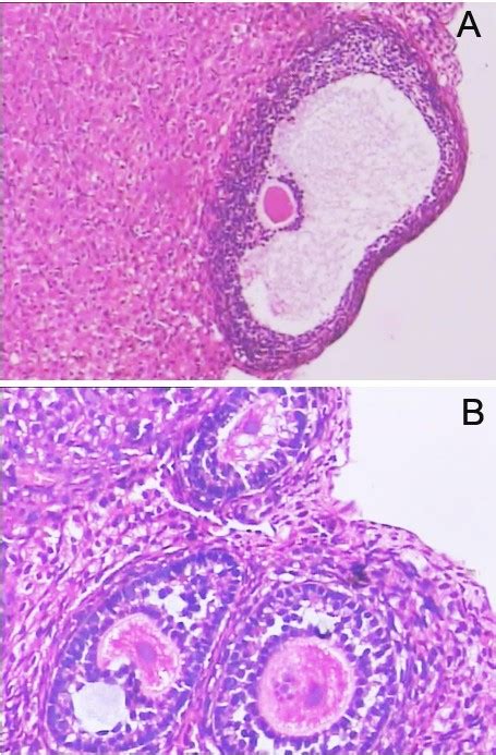 Polycystic Ovary Syndrome Resembling Histopathological Alterations In