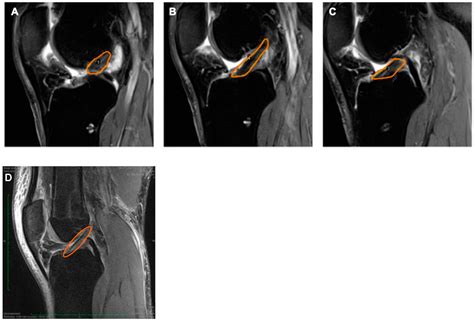 Jcm Free Full Text Extracorporeal Shockwave Therapy Improves