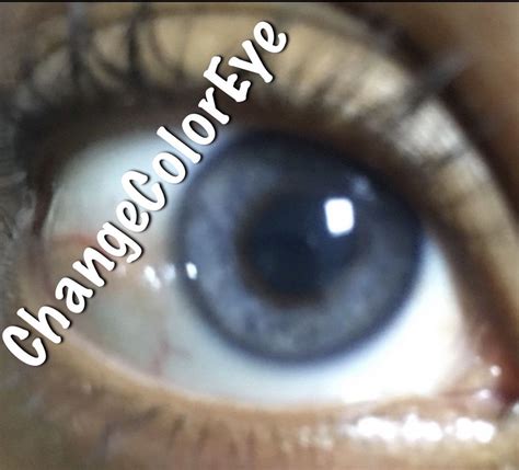 Laser Eye Color Change Surgery Before And After - Colorxml