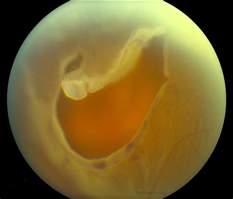 Atlas Entry - Rhegmatogenous retinal detachment