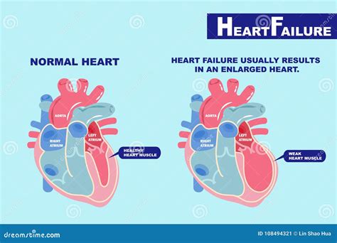 Cartoon Heart Failure Stock Illustrations – 566 Cartoon Heart Failure Stock Illustrations ...