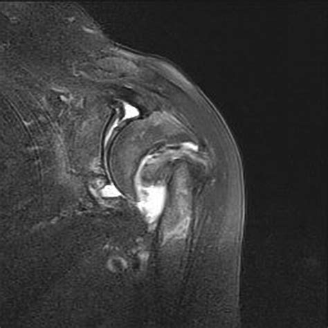 Humerus Head Fracture