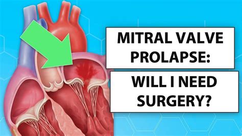 Mitral Valve Prolapse Symptoms Diagnosis And Treatment Off