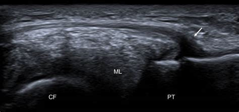 Échographie du ligament antérolatéral du genou comment et pourquoi