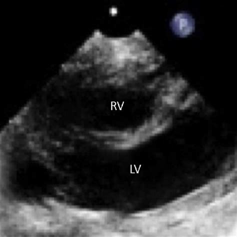 Two Dimensional Transthoracic Echocardiographic Image Obtained In