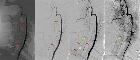 Spinal Arterial Anatomy | neuroangio.org