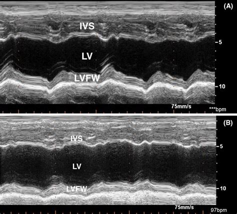 M Mode Echocardiogram Of The Left Ventricle Of An Unaffected Control