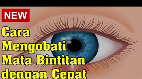 5 Cara Mudah Dan Ampuh Mengobati Mata Bintitan Dengan Cepat Tanpa