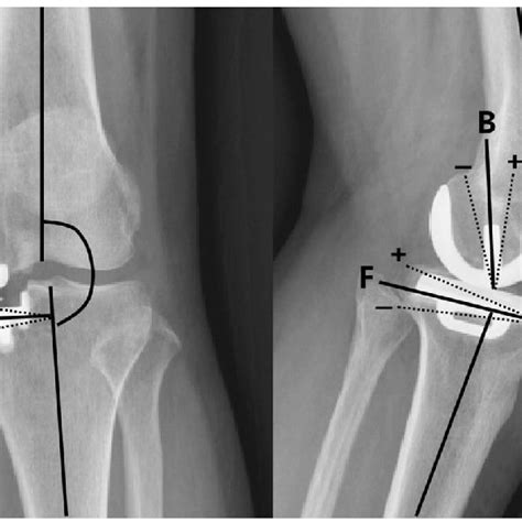 Measurement Of FTA And Component Alignments FTA Femorotibial Angle