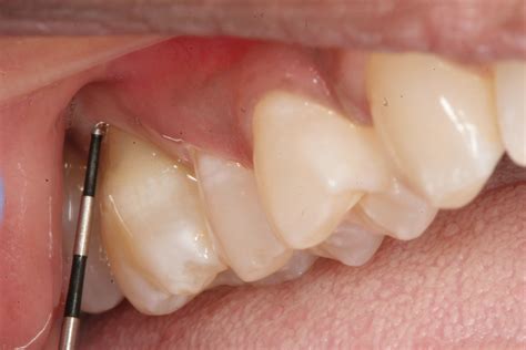 Before And After Pictures Of Non Invasive Rpe Periodontal Disease