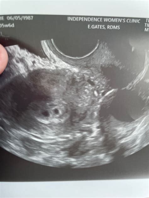 Possible Twins 5w5d Ultrasound Multiples And Twins Forums What