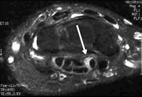 Mri Carpal Tunnel